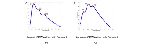 icp pulse morphology  normal icp waveform  dominant p   scientific