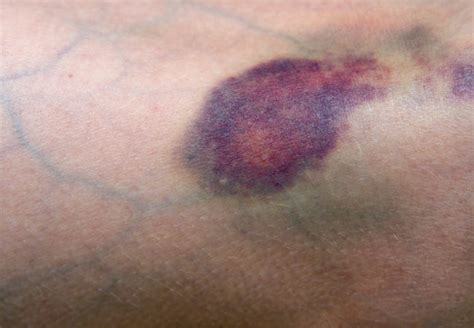 Baffled By Bruises When To Get Them Checked Out Health