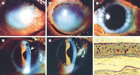 Early Results Of Penetrating Keratoplasty After Cultivated Limbal