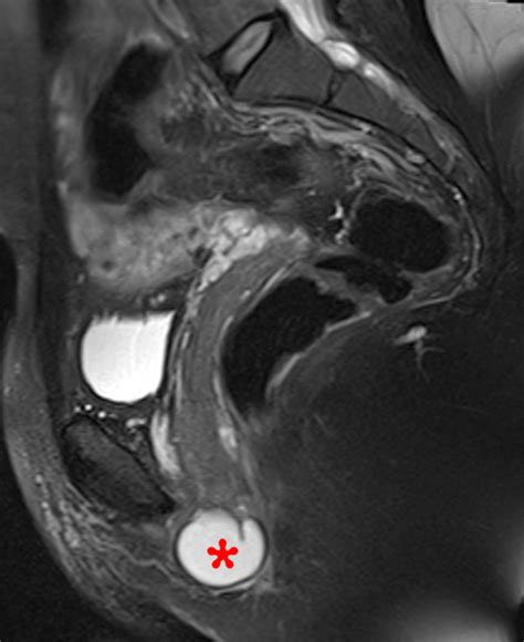 Gynecological Findings Encountered On Musculoskeletal Mri Radsource