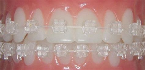 simpliclear braces the wire is clear unlike typical