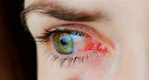 alergias en ojos y oídos síntomas y manifestaciones salud al día