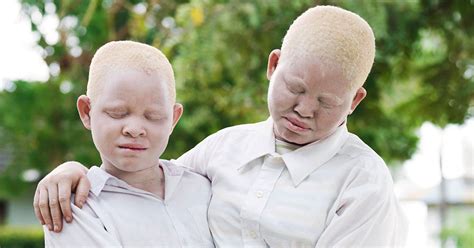 albino children  hunted tanzania photo series