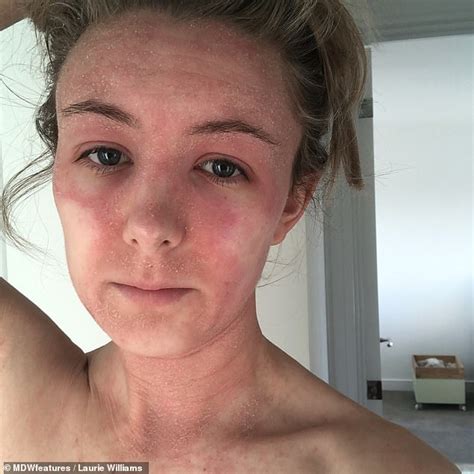 Eczema Sufferer Endures Flaking Skin Since Ditching Her Steroid Creams