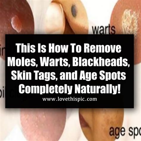 this is how to remove moles warts blackheads skin tags