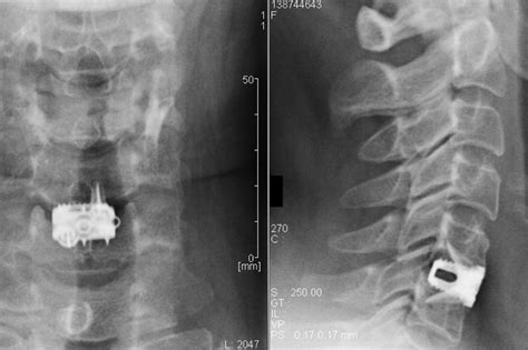 Anterior Cervical Discectomy Fusion Comprehensive Spinecare