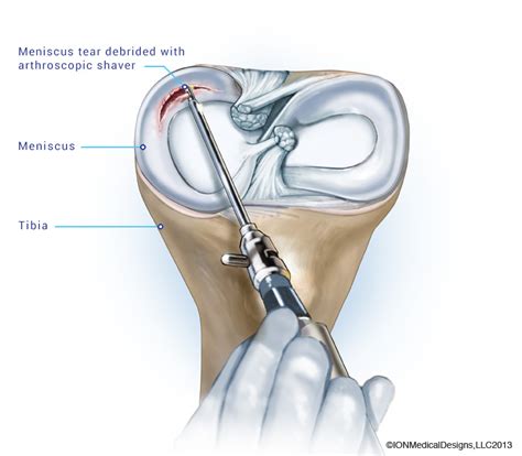 meniscus repair joint preservation center