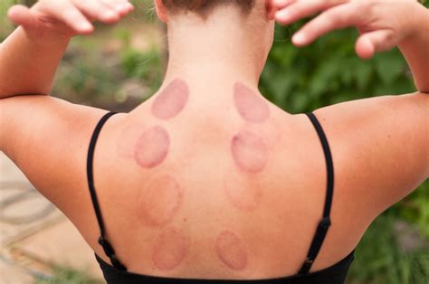 wet cupping or hijama the ancient art of healing green prophet impact news for the middle