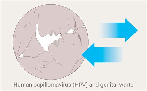 genital hpv infection fact sheet jsr communications