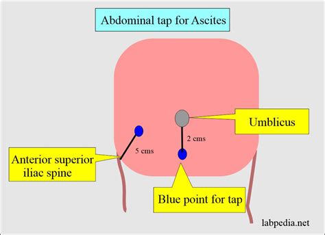 Fluid Analysis Part 4 Ascitic Fluid Abdominal Paracentesis