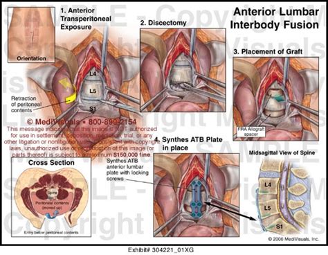 Anterior Interbody Lumbar Fusion Anterior Lumbar