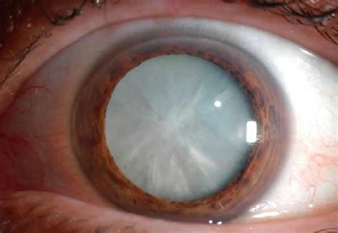 cataract  wimpole eye clinic