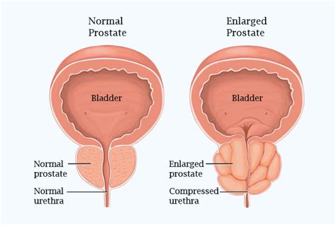 prostate issues… prostate cymru