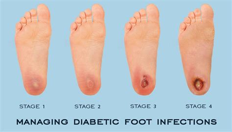 diabetes   feet premier foot ankle center  stars