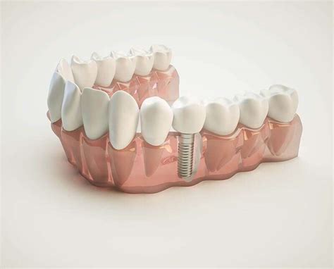 quanto custa em média um implante dentário consulta ideal