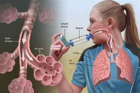 status asthmaticus definition  symptoms diagnosis treatment