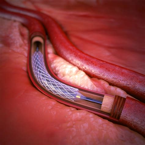 coronary artery stent  max