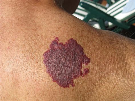 birthmark removal forefront dermatology