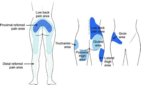 illustration  distribution pattern related  facet joint pain  scientific diagram