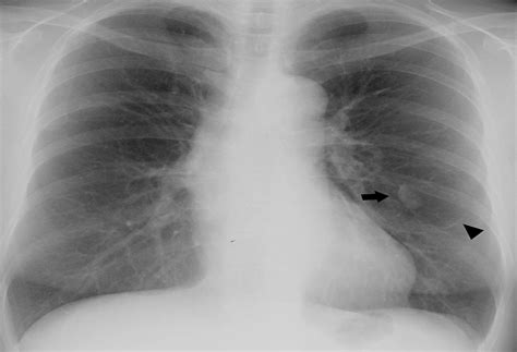 A Case Of Pulmonary Sclerosing Hemangioma Surrounded By Gian