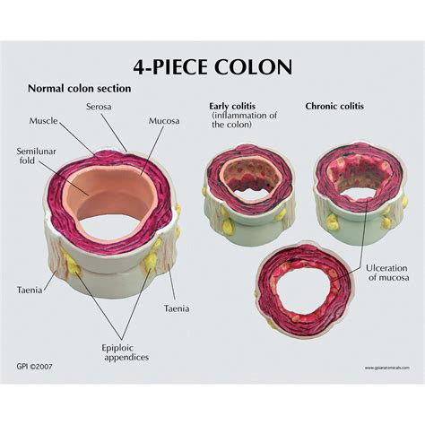 colon en  pieces avec pathologies gpi  modele de colon