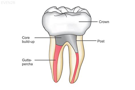 root canal post crown  tooth ideal dental care