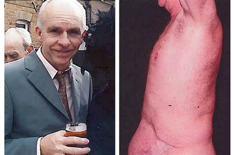 man who lost his penis to flesh eating superbug after routine surgery