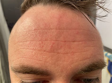 skin concerns  forehead constantly        rskincareaddiction