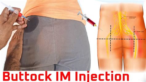 give  intermuscular im injection  gluteal muscle  home buttock injection