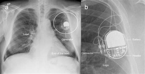 pacemakers  implantable cardioverter defibrillators unknown  chest radiography review