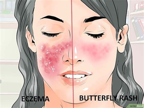 eczema  butterfly rash  steps  pictures lupus