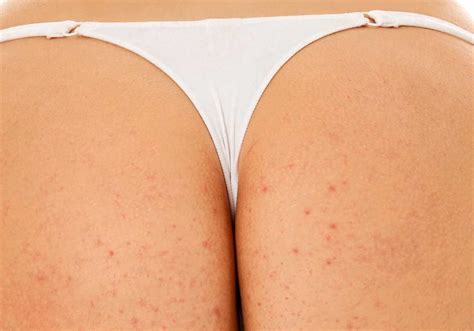 Pimples On Buttocks How To Get Rid Of Them Best Acne