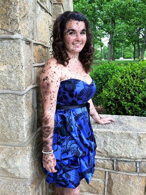 bullied teen covered in birthmarks is confident in herself