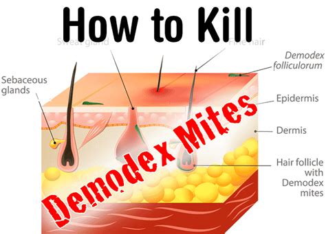 kill demodex mites healthy focus