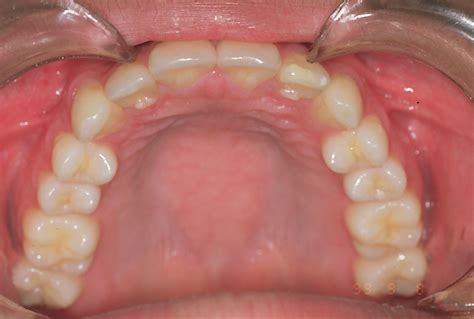 paciente com deficiência mandibular tratamento compensatório cesar bigarella