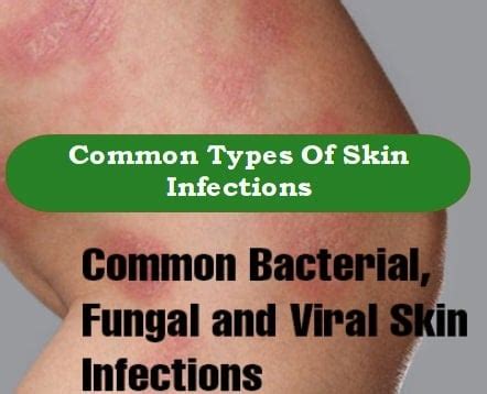 bacterial fungal viral skin infections common signs symptoms types  treatment
