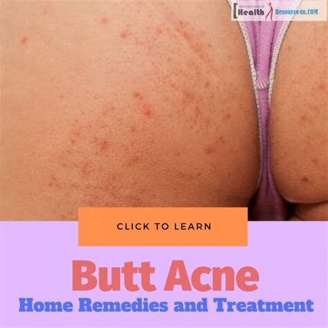 How To Get Rid Of Butt Acne Home Remedies And Treatment