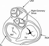 Coronary Sinus Ostium Arteries sketch template