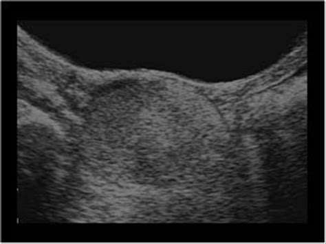 Gynaecology 3 2 Adnexa Case 3 2 2 Dermoid Cysts