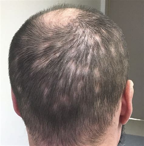 hair loss due to std yes that s possible check out