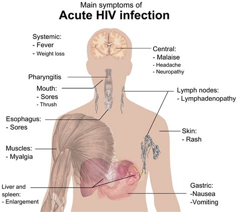 File Symptoms Of Acute Hiv Infection Png Wikimedia Commons