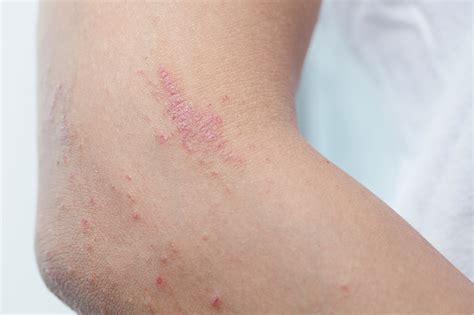 common skin lesions valley county health system