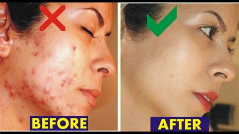 how to get rid of acne stains and pimple marks naturally with tricky