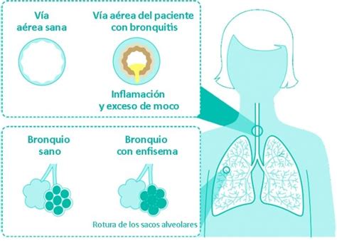 Diferencia Entre Bronquitis Enfisema Y Epoc Tu Canal De Salud