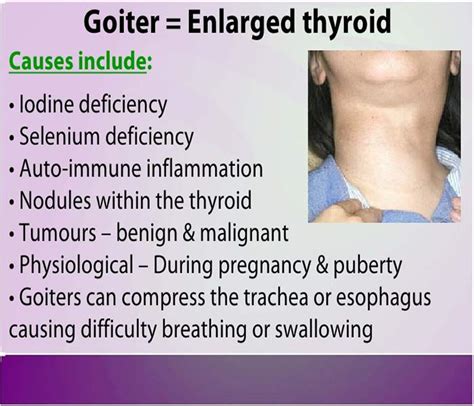 thyroid goiter  symptoms treatment diagnosis  prevention