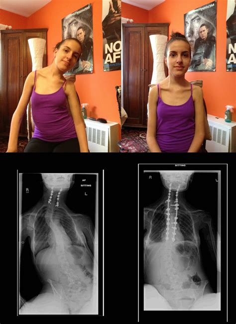 X Rays And Pictures Of Me Before And After My Spinal