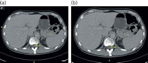 Sex Differences In The Splenic Flexure The Annals Of The Royal