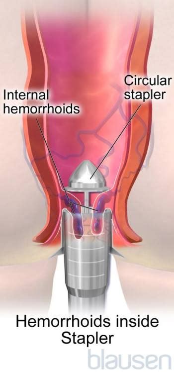 Hemorrhoids Digestive Disorders Merck Manuals Consumer
