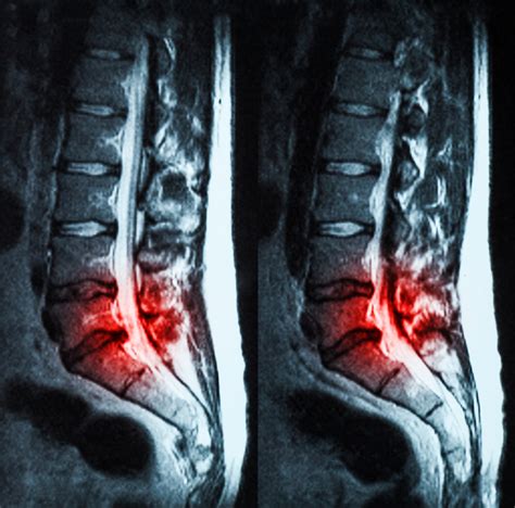symptoms  severe spinal stenosis    premia spine