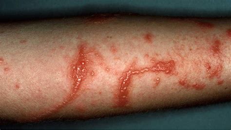 dermatitis contact atopic perioral nummular seborrheic stasis